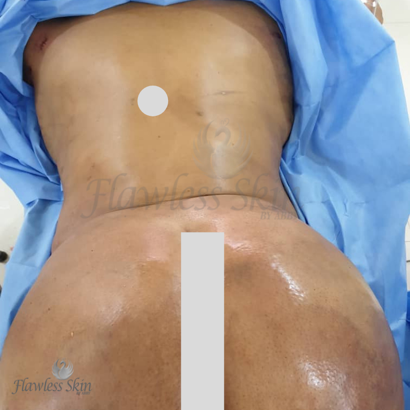 Brazilian Butt Lift Before and After | Flawless Aesthetic Center