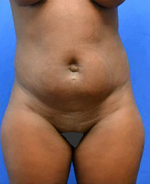 Liposuction Nigeria, Liposuction Abuja