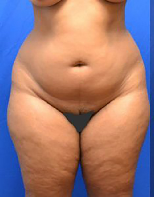 Liposuction Nigeria, Liposuction Abuja