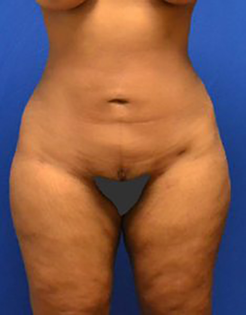 Liposuction Nigeria, Liposuction Abuja