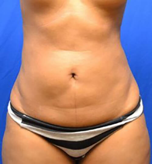 Liposuction Nigeria, Liposuction Abuja