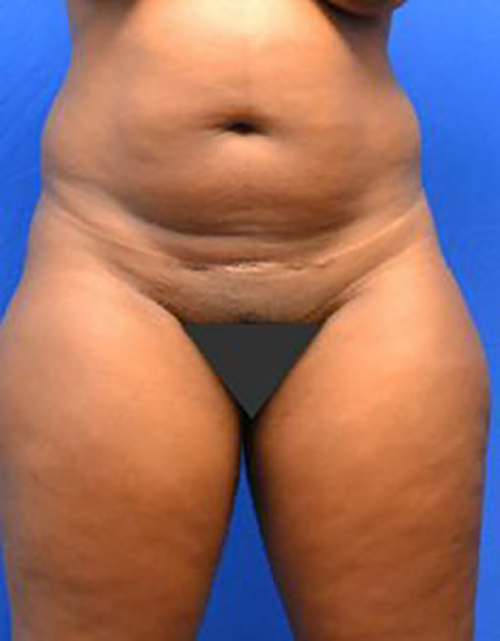 Liposuction Before and After | Flawless Aesthetic Center