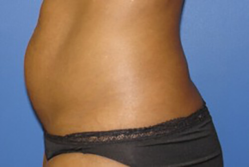 Liposuction Before and After | Flawless Aesthetic Center