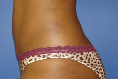 Liposuction Before and After | Flawless Aesthetic Center