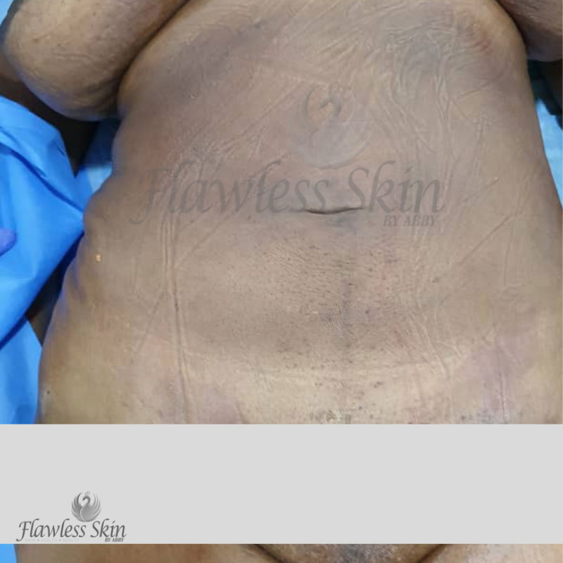 Liposuction Before and After | Flawless Aesthetic Center