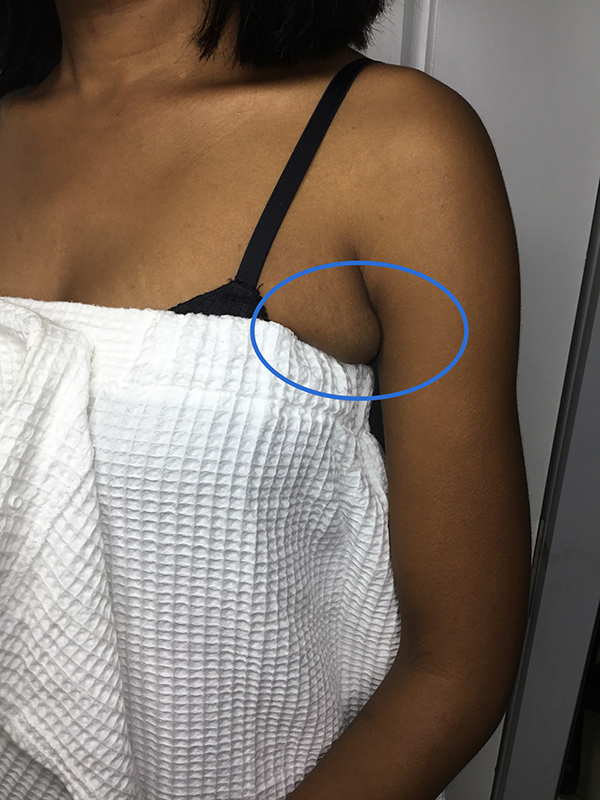 Liposuction Before and After | Flawless Aesthetic Center