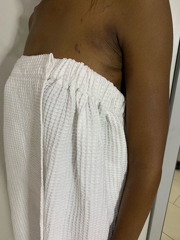 Liposuction Before and After | Flawless Aesthetic Center