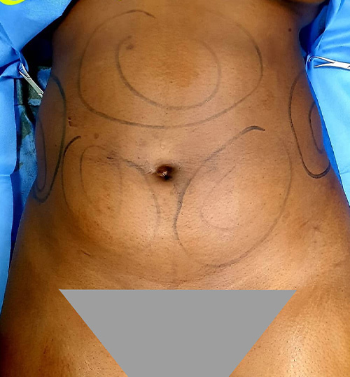 Liposuction Before and After | Flawless Aesthetic Center