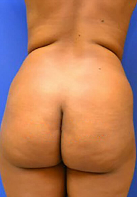 Liposuction Before and After | Flawless Aesthetic Center