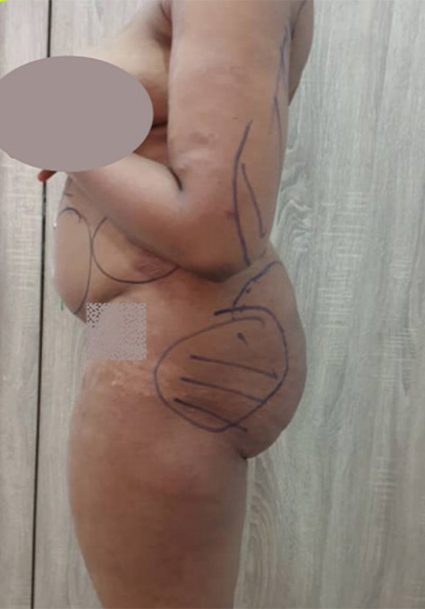 Liposuction Before and After | Flawless Aesthetic Center