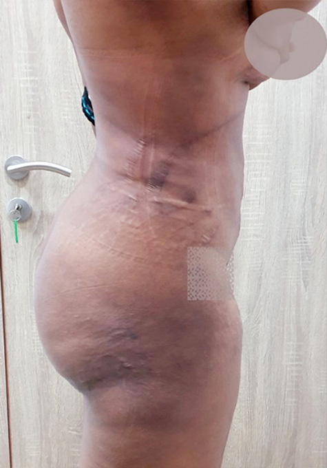 Liposuction Before and After | Flawless Aesthetic Center