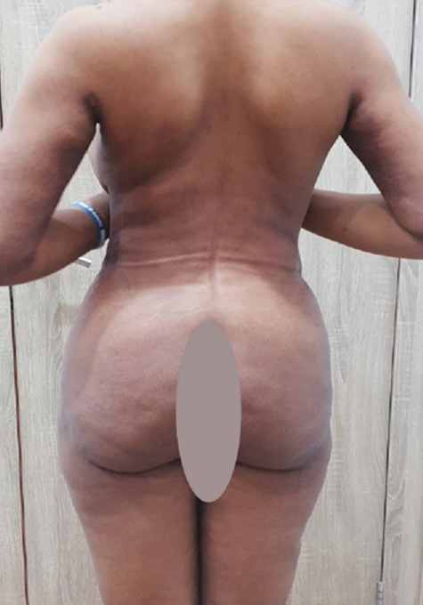 Liposuction Before and After | Flawless Aesthetic Center