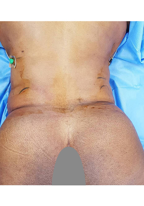 Liposuction Before and After | Flawless Aesthetic Center