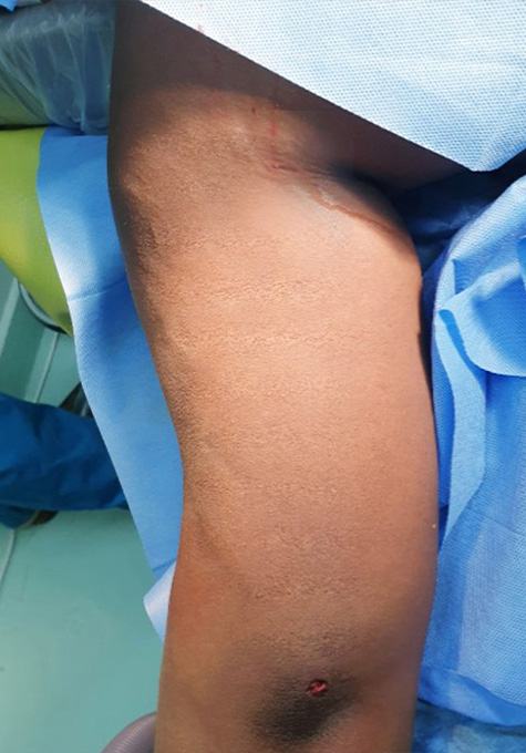 Liposuction Before and After | Flawless Aesthetic Center