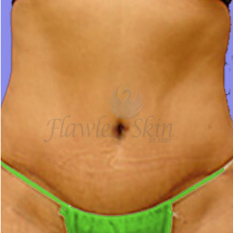 Tummy Tuck Nigeria