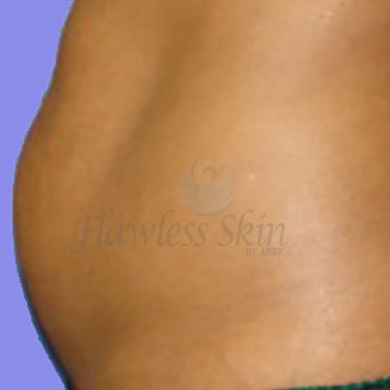 Tummy Tuck Before and After | Flawless Skin