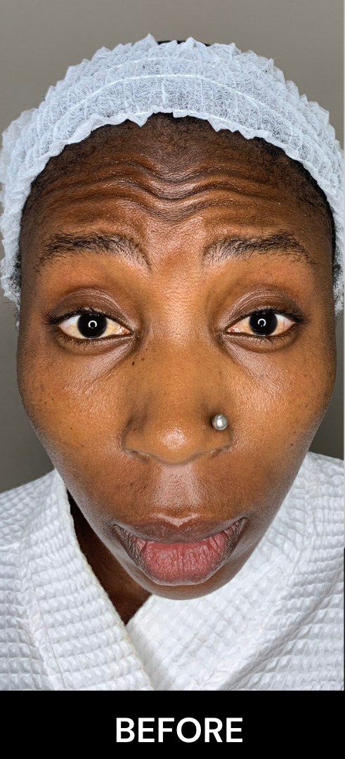 Botox Nigeria