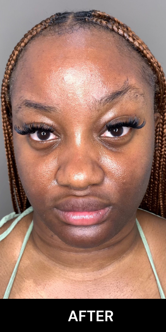 Botox Before and After | Flawless Aesthetic Center