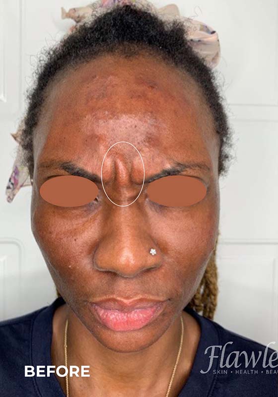 Botox Before and After | Flawless Aesthetic Center