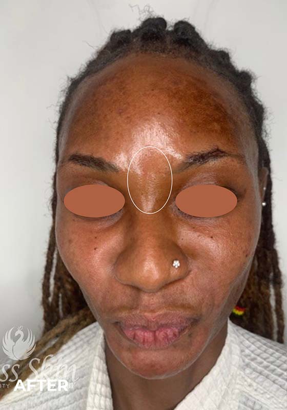 Botox Before and After | Flawless Aesthetic Center