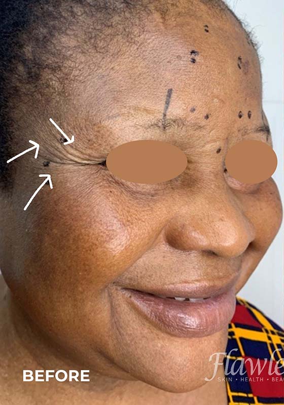 Botox Before and After | Flawless Aesthetic Center