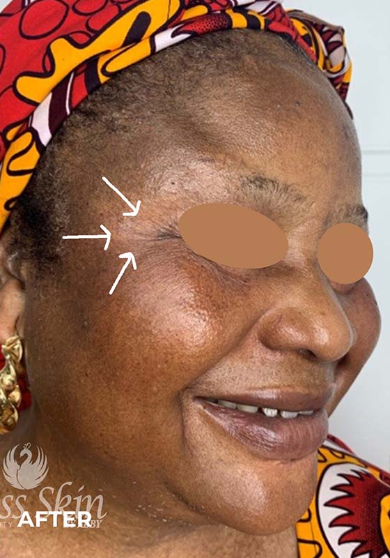 Botox Before and After | Flawless Aesthetic Center