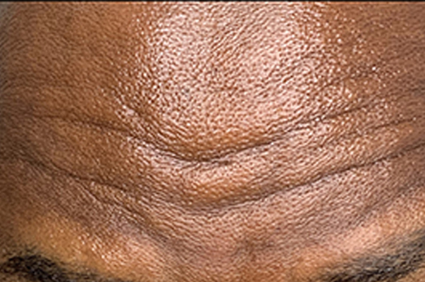 Botox Before and After | Flawless Aesthetic Center