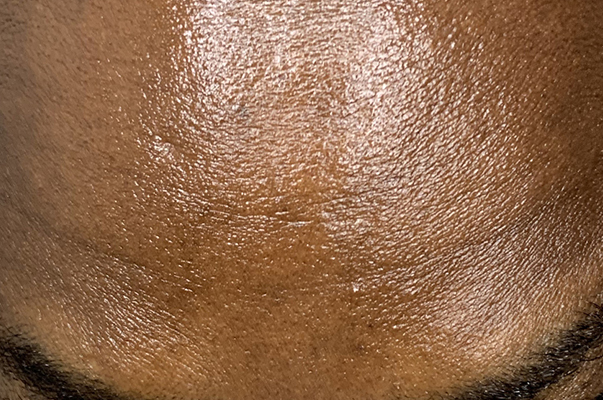 Botox Before and After | Flawless Aesthetic Center