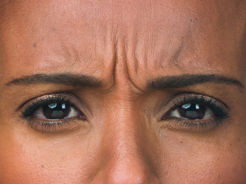 Botox Before and After | Flawless Aesthetic Center