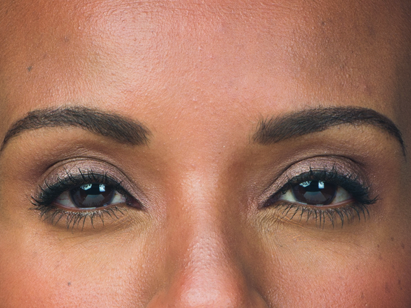 Botox Before and After | Flawless Aesthetic Center