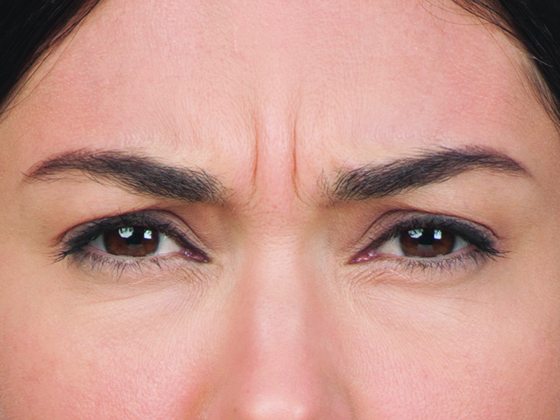 Botox Before and After | Flawless Aesthetic Center