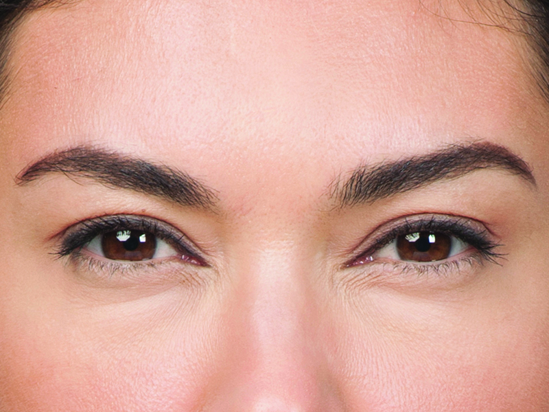 Botox Before and After | Flawless Aesthetic Center