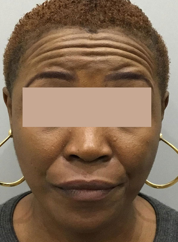 Botox Before and After | Flawless Aesthetic Center