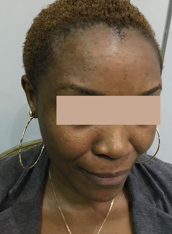 Botox Before and After | Flawless Aesthetic Center
