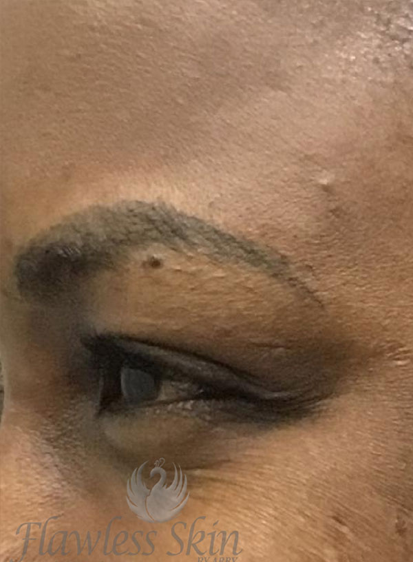 Botox Before and After | Flawless Aesthetic Center