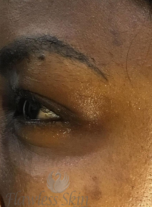 Botox Before and After | Flawless Aesthetic Center