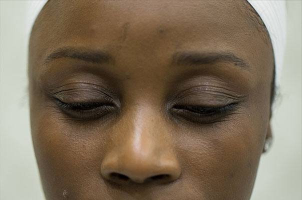 Botox Before and After | Flawless Aesthetic Center
