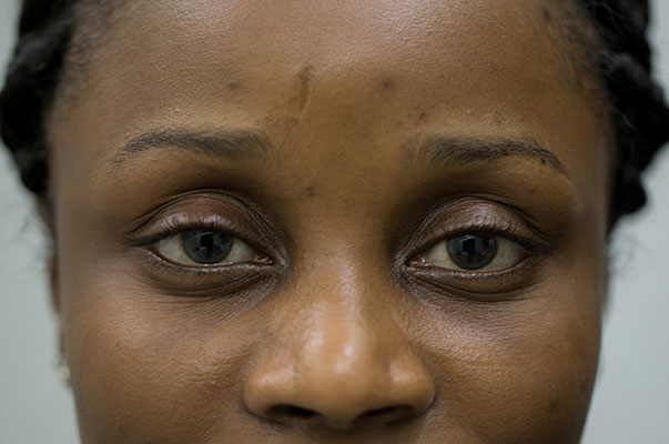Botox Before and After | Flawless Aesthetic Center