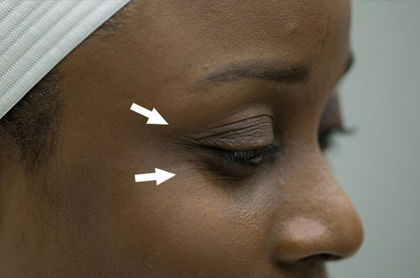 Botox Before and After | Flawless Aesthetic Center