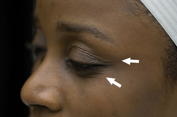 Botox Before and After | Flawless Aesthetic Center