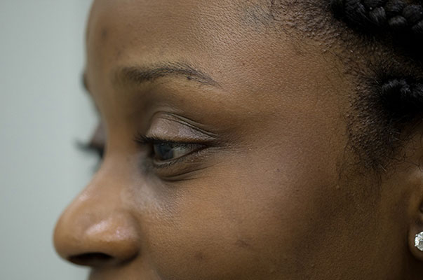 Botox Before and After | Flawless Aesthetic Center