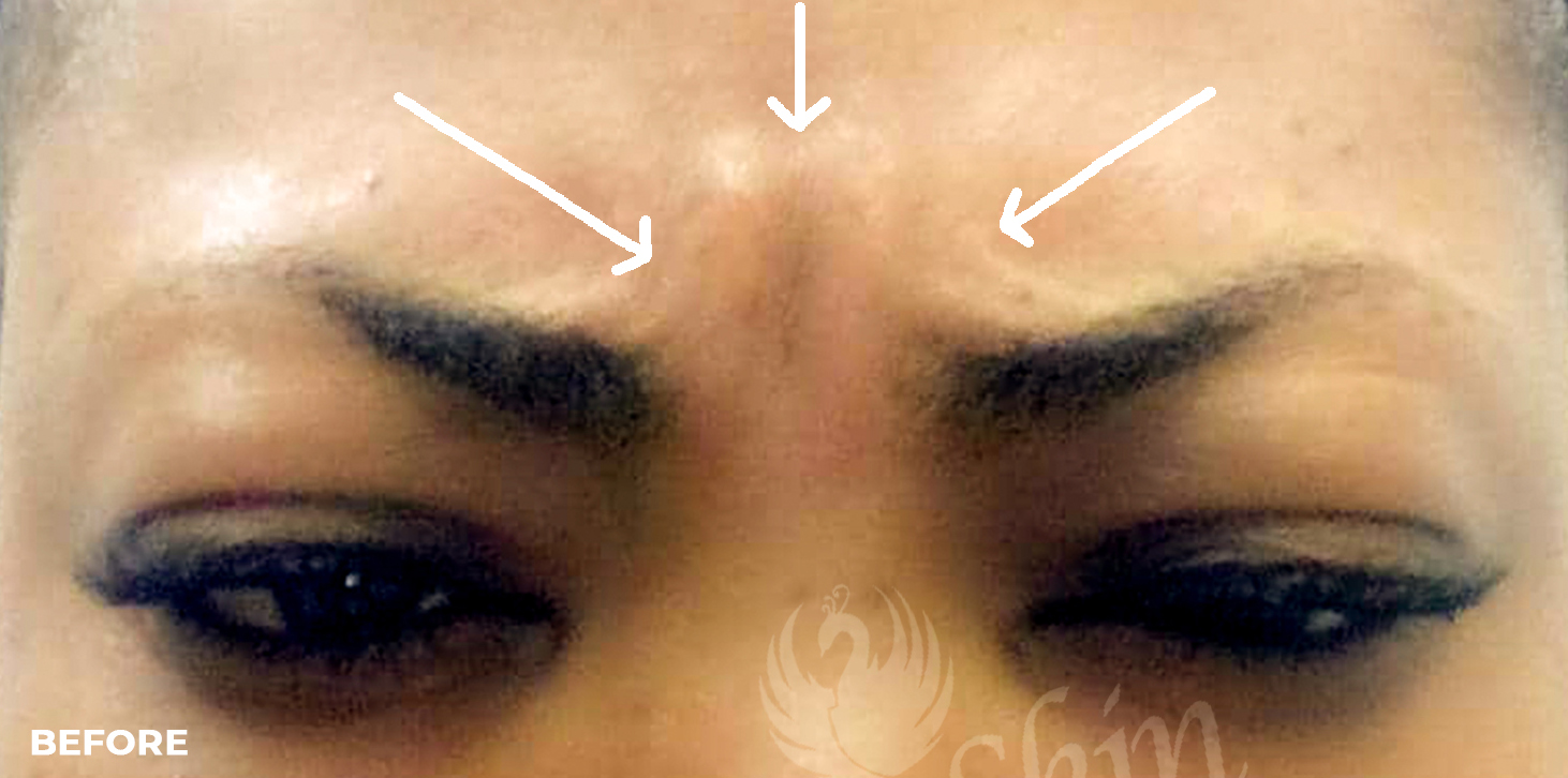 Botox Before and After | Flawless Aesthetic Center