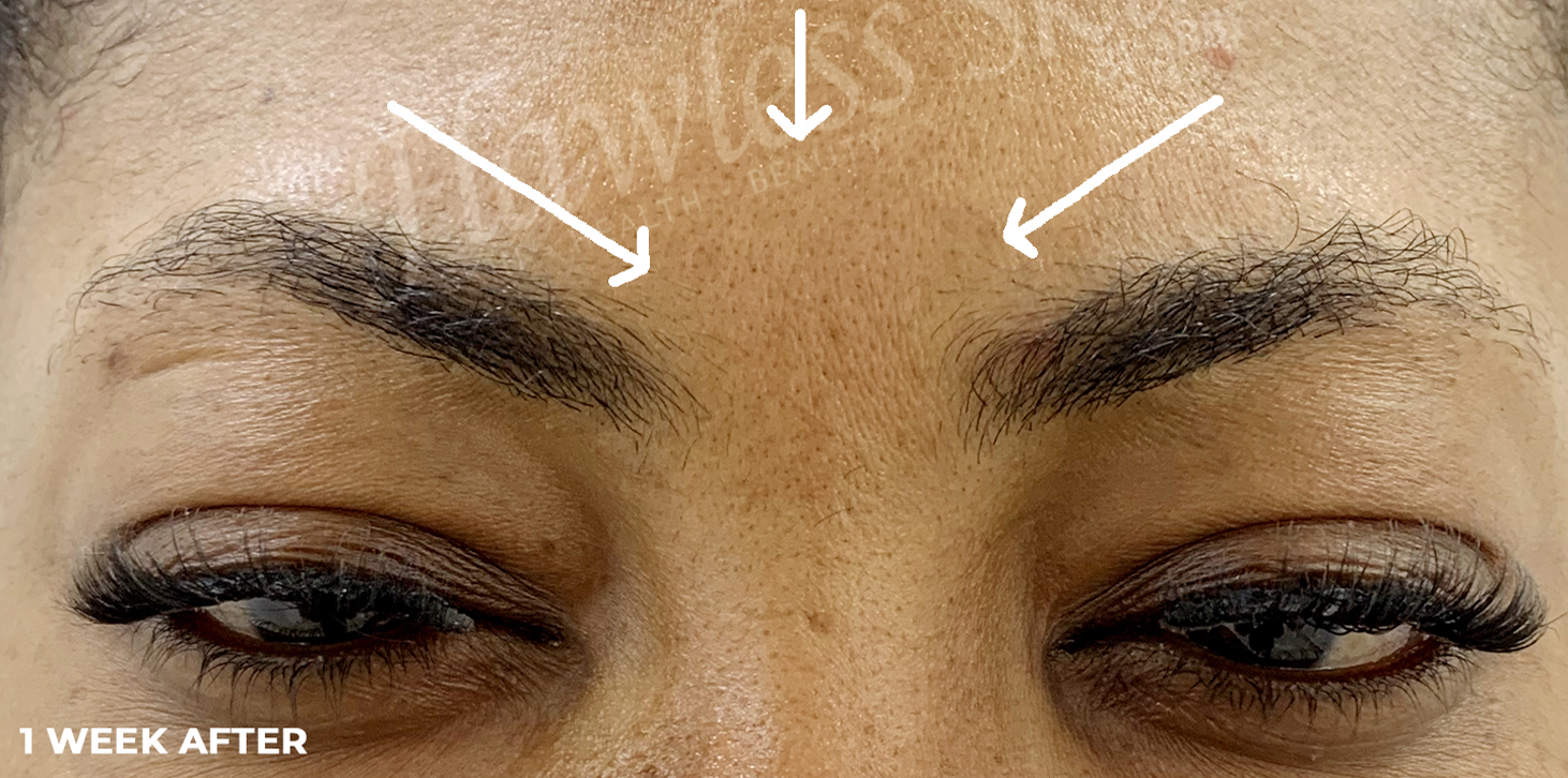 Botox Before and After | Flawless Aesthetic Center