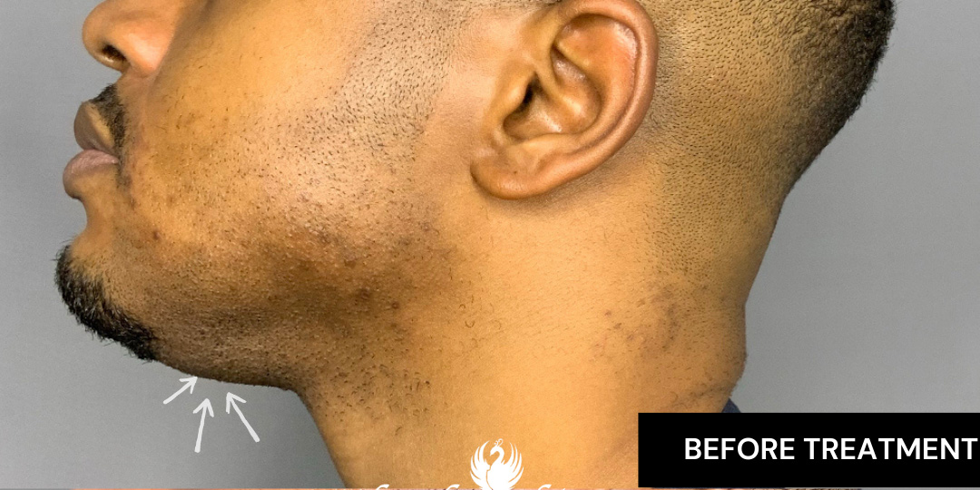 Kybella Nigeria