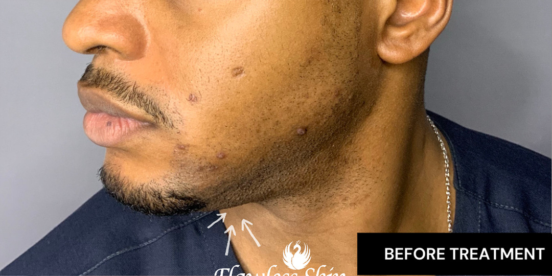 Chin Augmentation And Kybella Before and After | Flawless Aesthetic Center