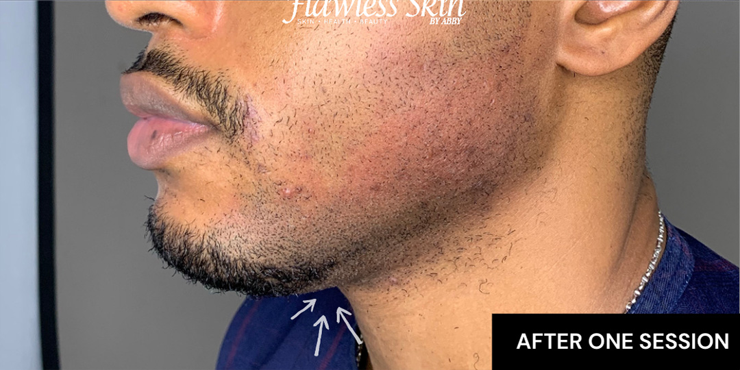 Chin Augmentation And Kybella Before and After | Flawless Aesthetic Center