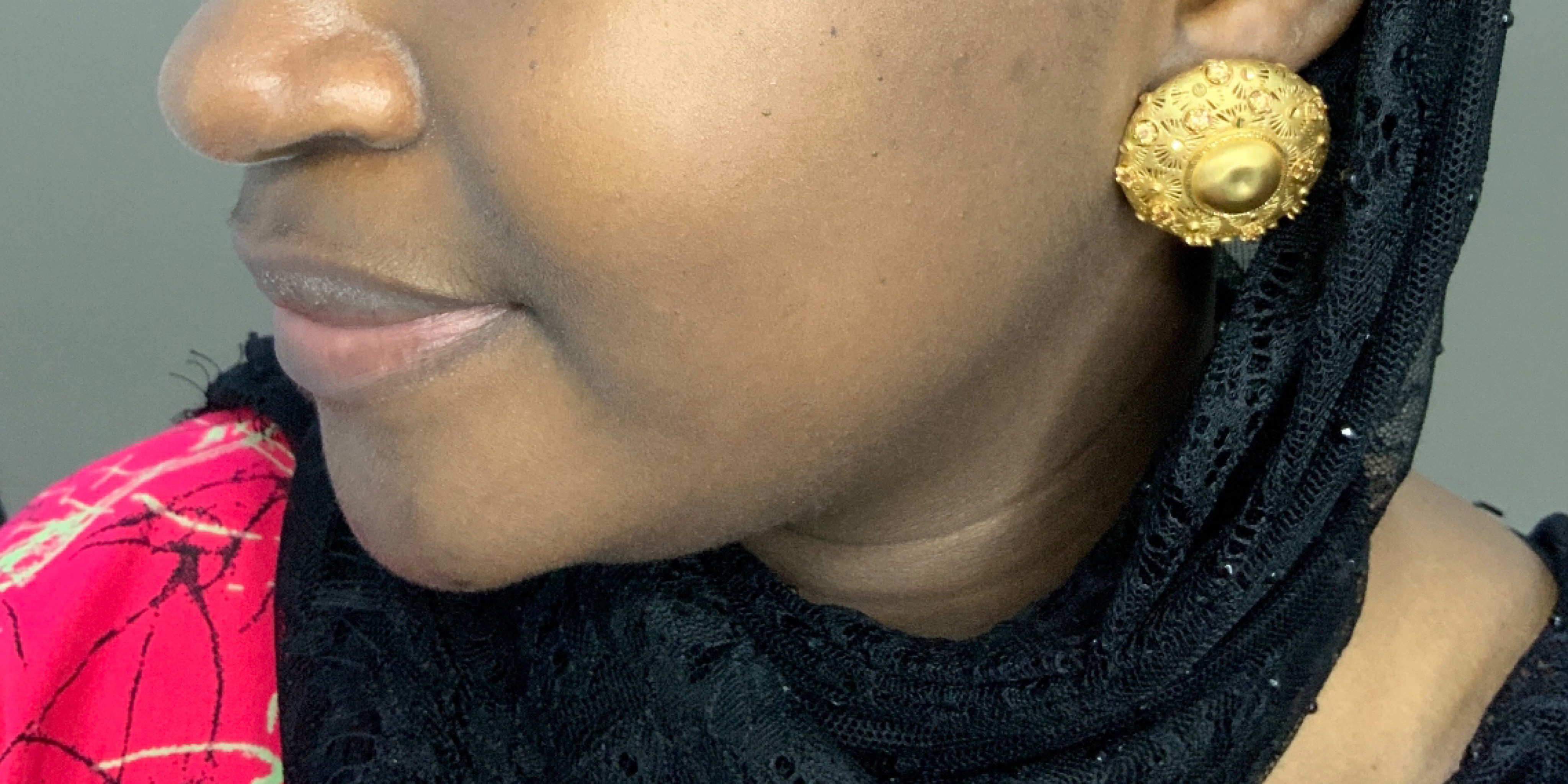 Chin Augmentation And Kybella Before and After | Flawless Aesthetic Center