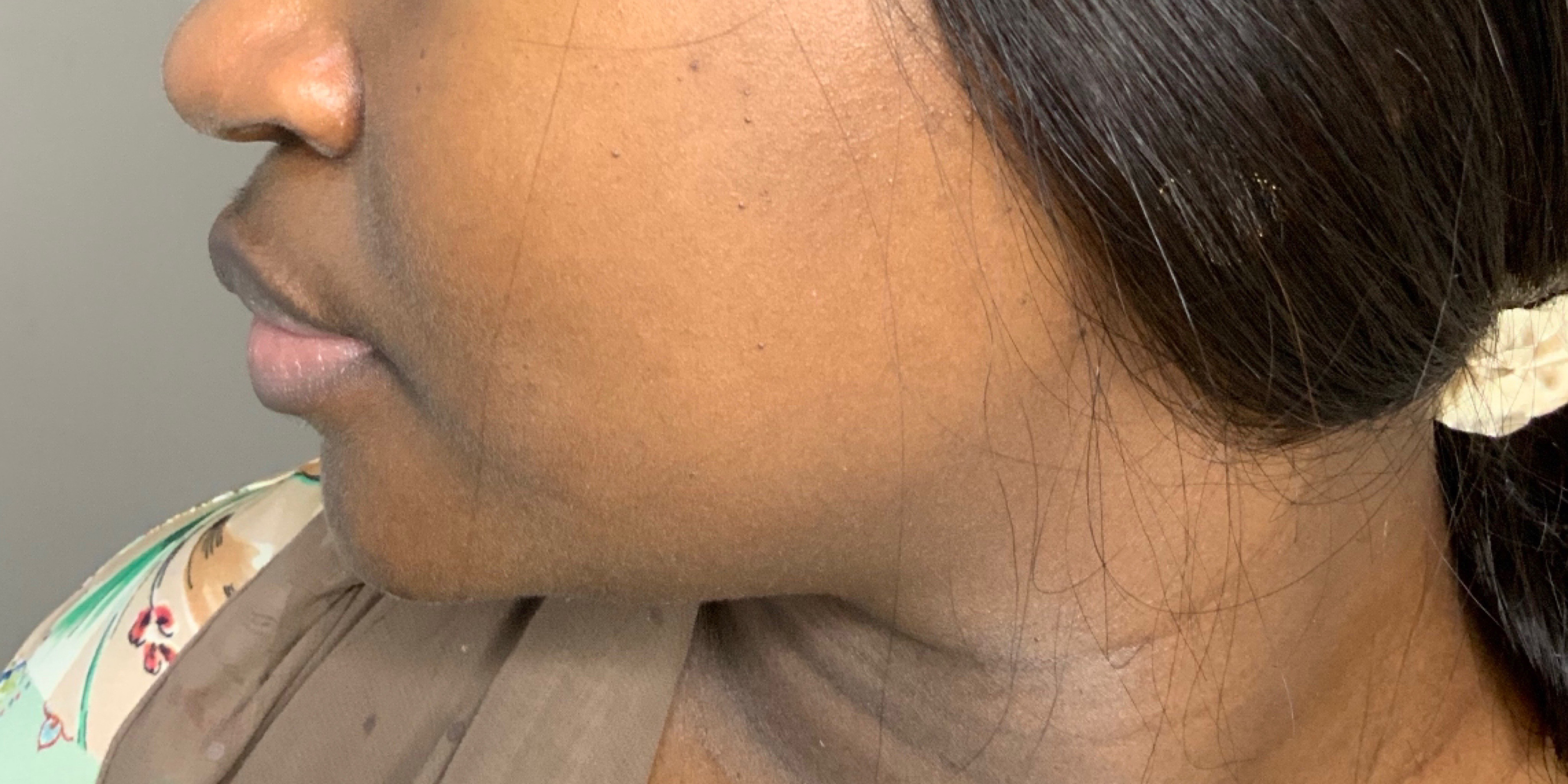 Chin Augmentation And Kybella Before and After | Flawless Aesthetic Center