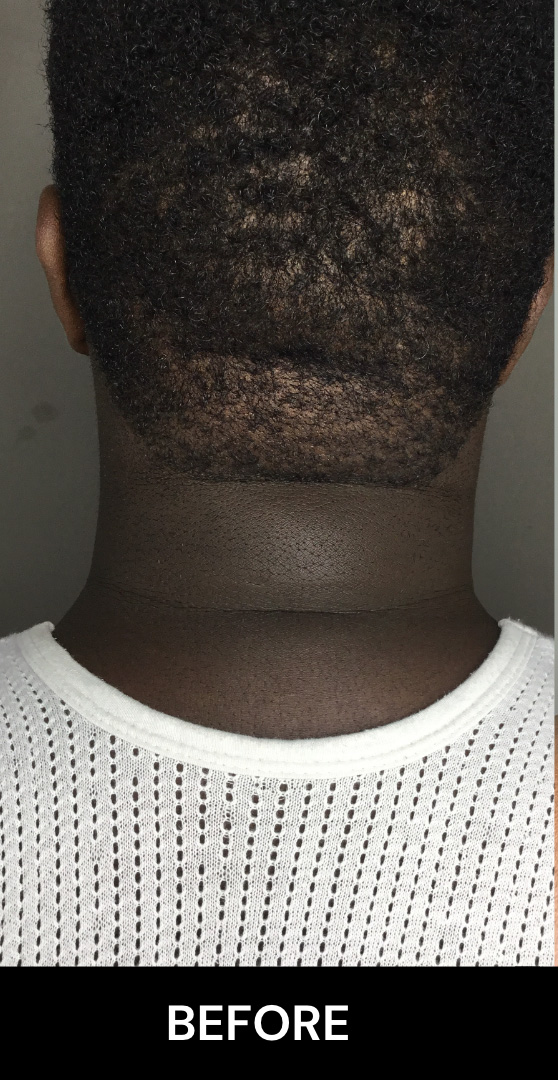Chin Augmentation And Kybella Before and After | Flawless Aesthetic Center