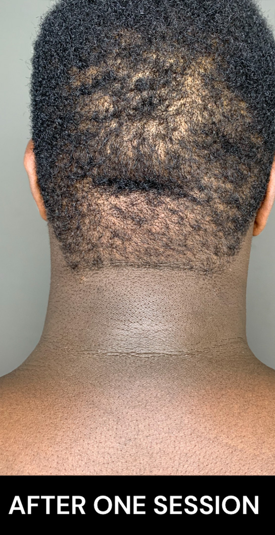 Chin Augmentation And Kybella Before and After | Flawless Aesthetic Center